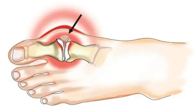 Gout