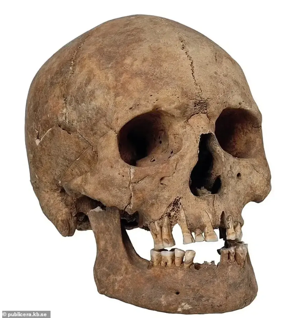 Viking Age Plastics: Remains of Women with Abnormally Long Skulls Discovered