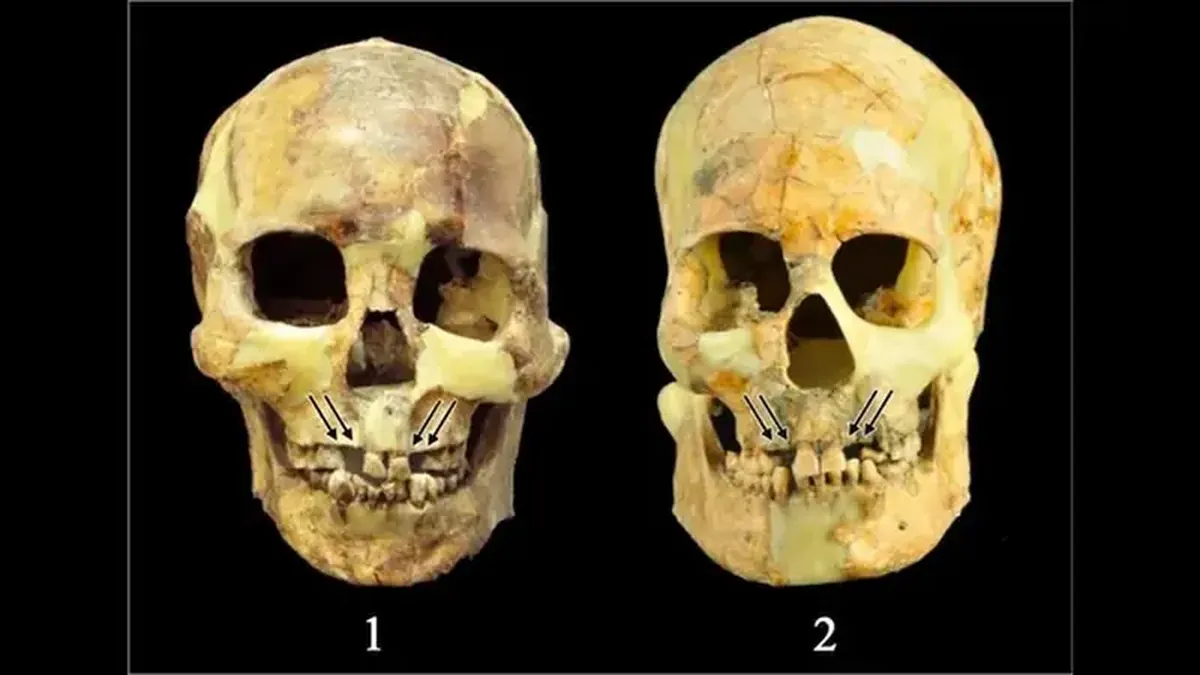 Beauty is a terrifying force: ancient Asians would remove perfectly healthy teeth.