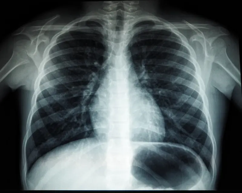 AI in Medicine: Diagnosis from X-ray Images