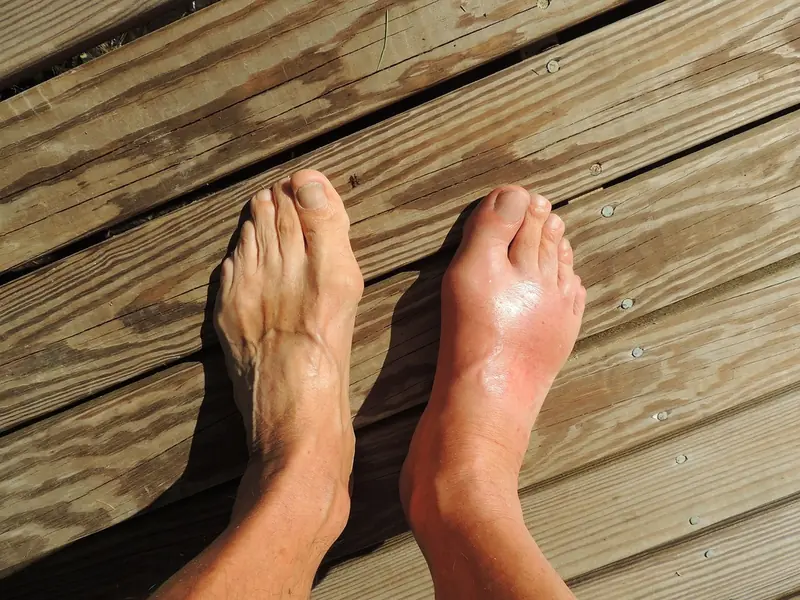 A surprise from genetics: researchers have identified the key cause of gout.