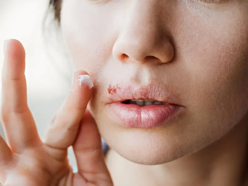 Researchers have found a link between herpes and Alzheimer's disease.