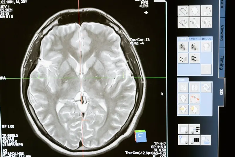 A single brain scan in midlife can determine the rate of physical aging.