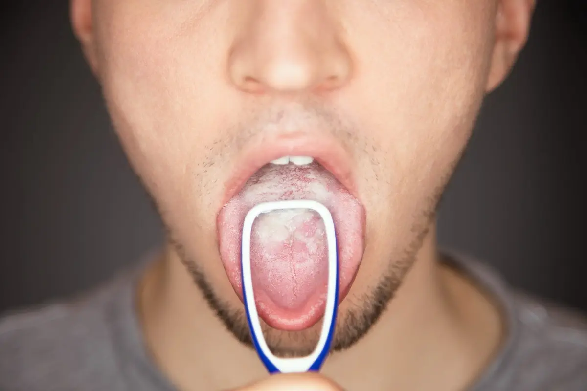 White Tongue