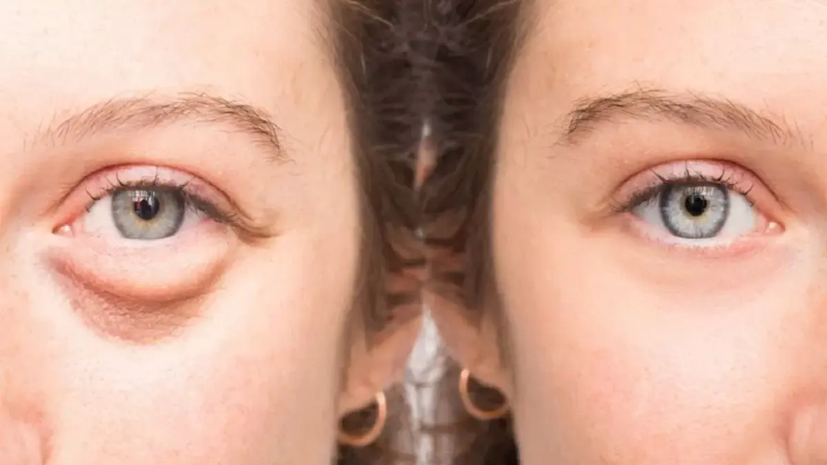 Enemies of Beauty: How to Fight Swelling