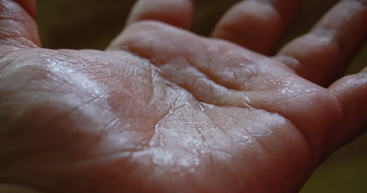 Sweaty palm