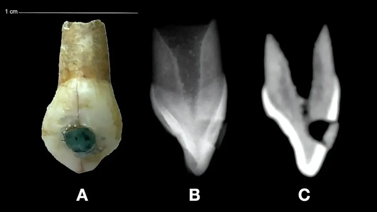 children's teeth with precious inlays