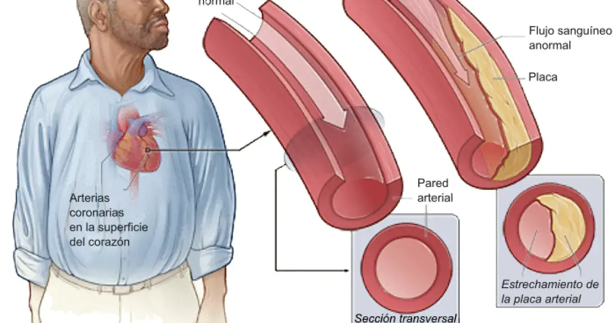 Atherosclerosis of blood vessels
