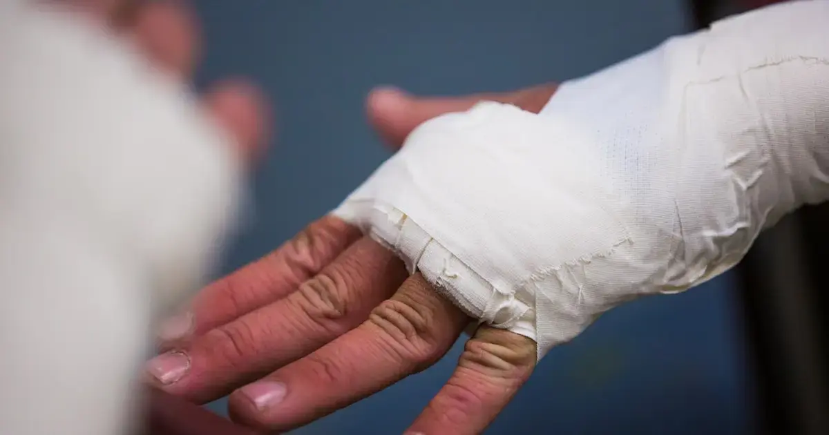 Scientists develop a glue gun for printing bone grafts on fractures