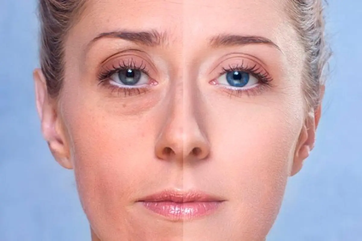 woman with and without bags under her eyes