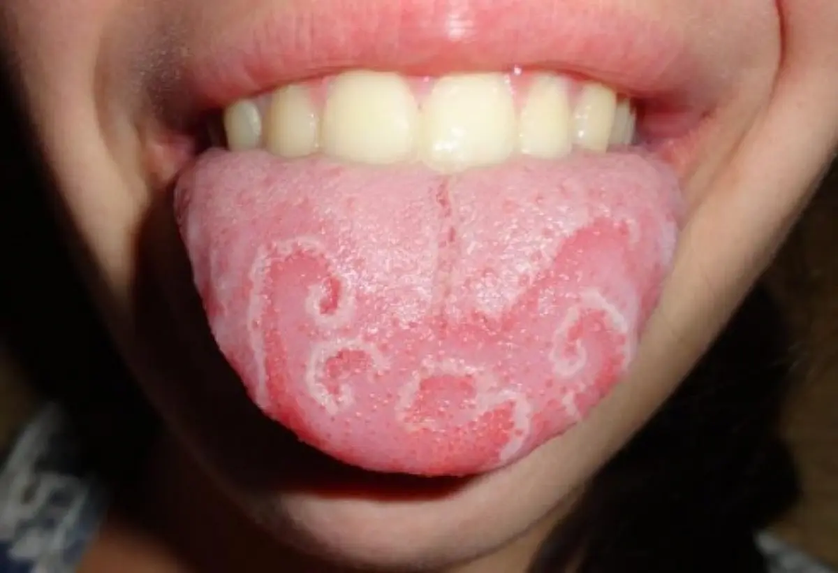 Coating on the Tongue
