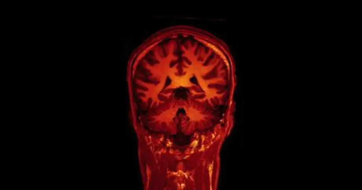 Brain MRI