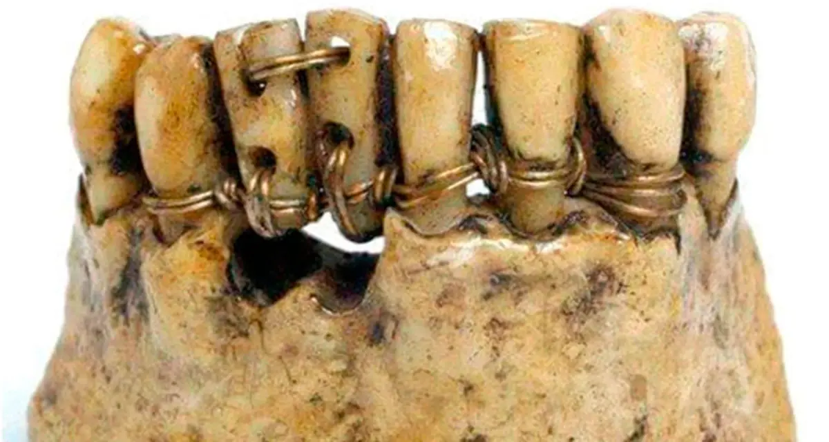 Wire on the teeth of an ancient skull