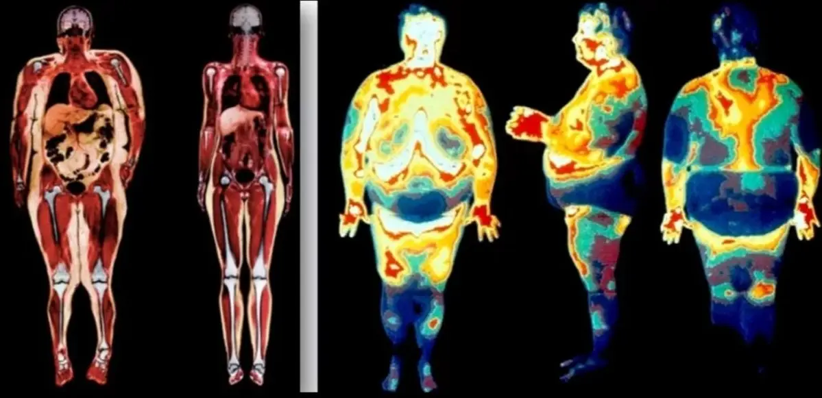 Scan showing how fat is deposited inside the body